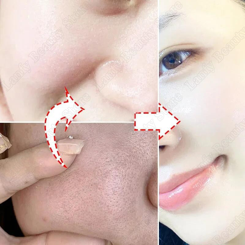 Creme para diminuir poros com ácido salicílico