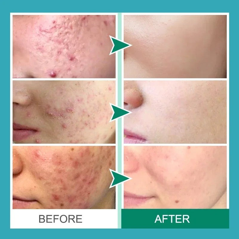 Creme de remoção de acne com ácido salicílico