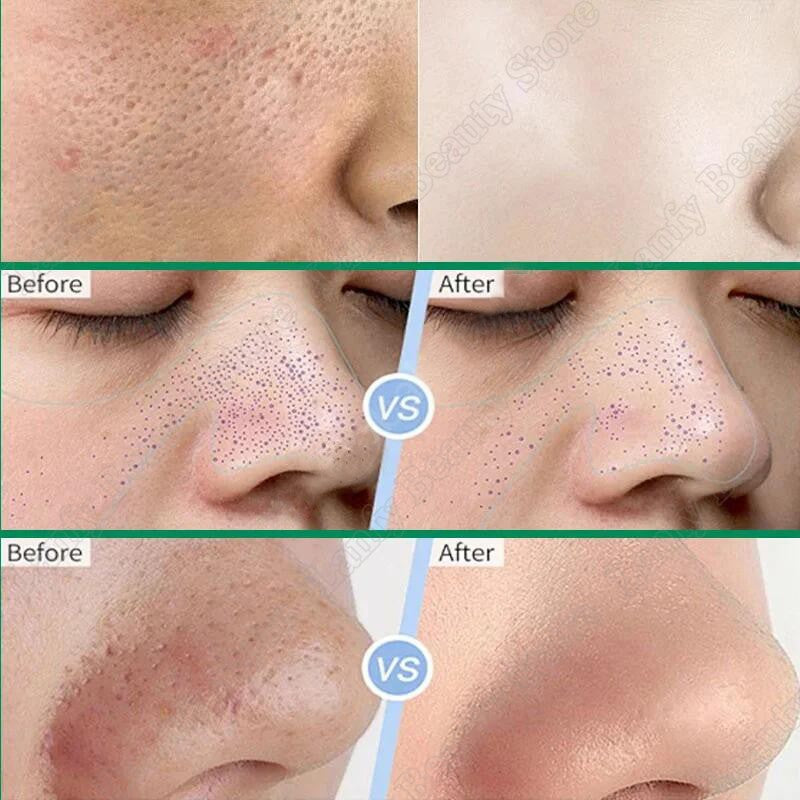 Creme para diminuir poros com ácido salicílico